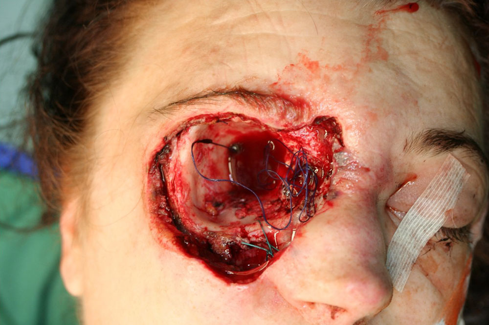 Nach Resektion der Malformation