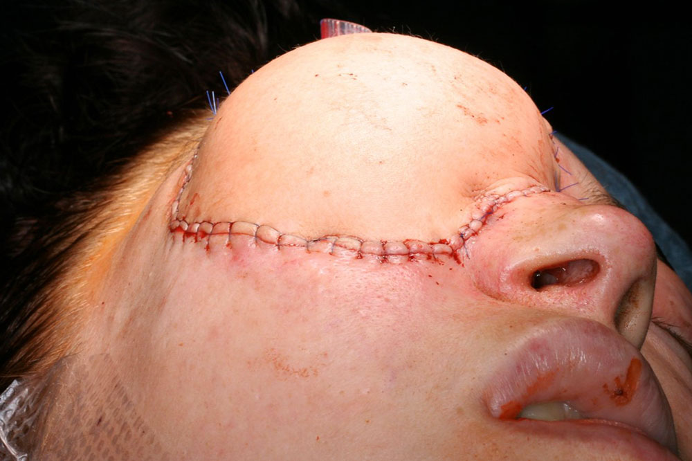 Rekonstruktion mit Latissimus dorsi Lappen