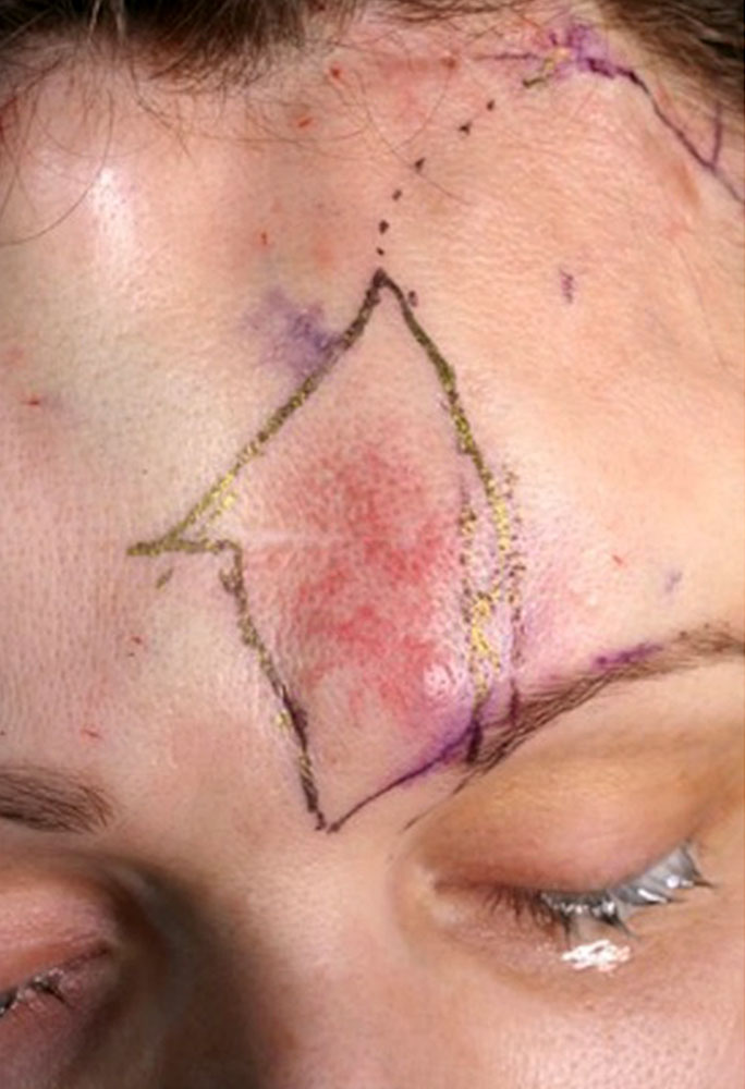 Arteriovenöse Malformation nach Operation