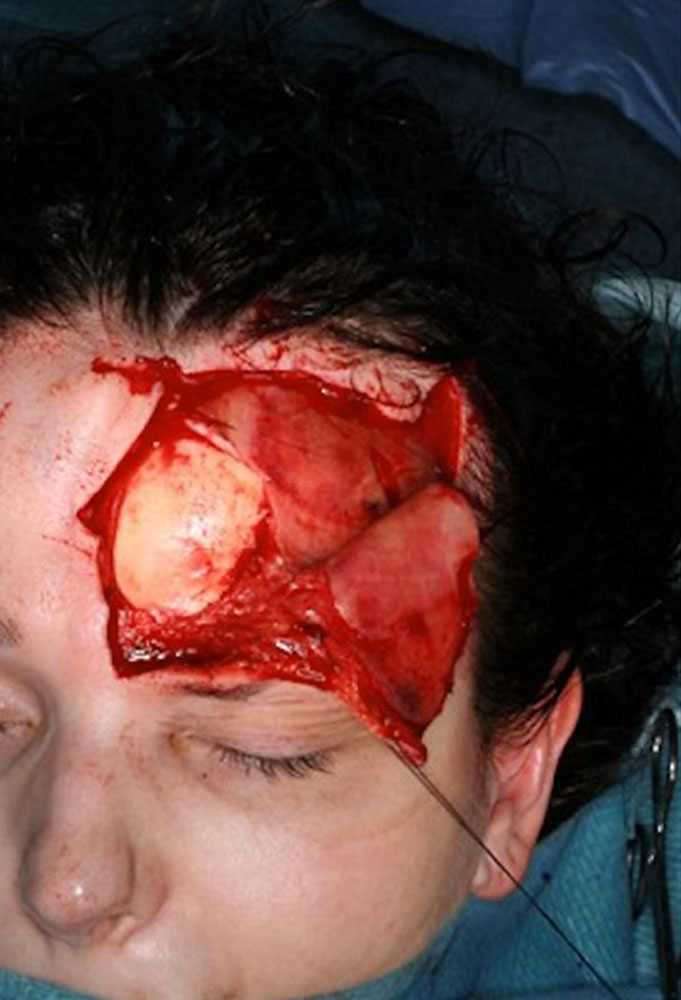 Resektion der Malformation