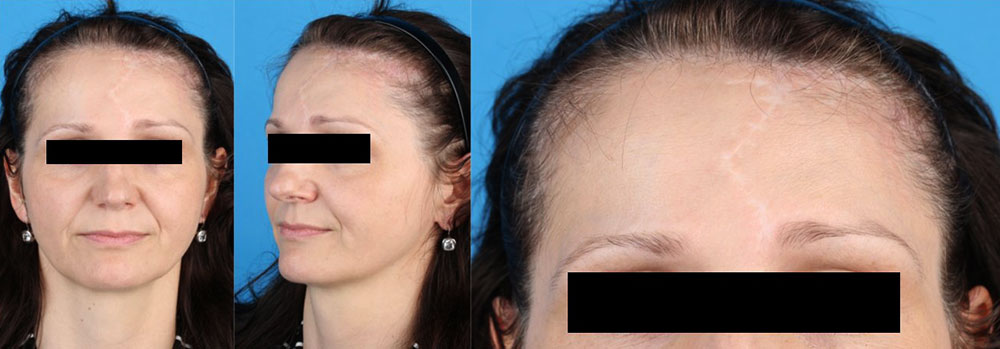 Ausheilungsergebnis nach Operation