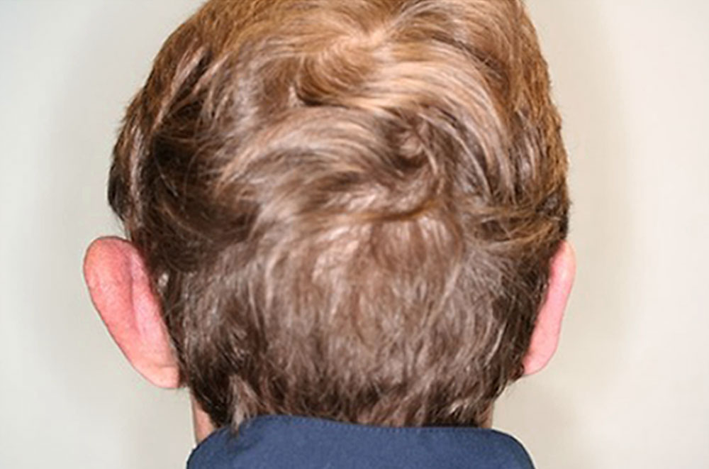 Arteriovenöse Malformation – Ohr