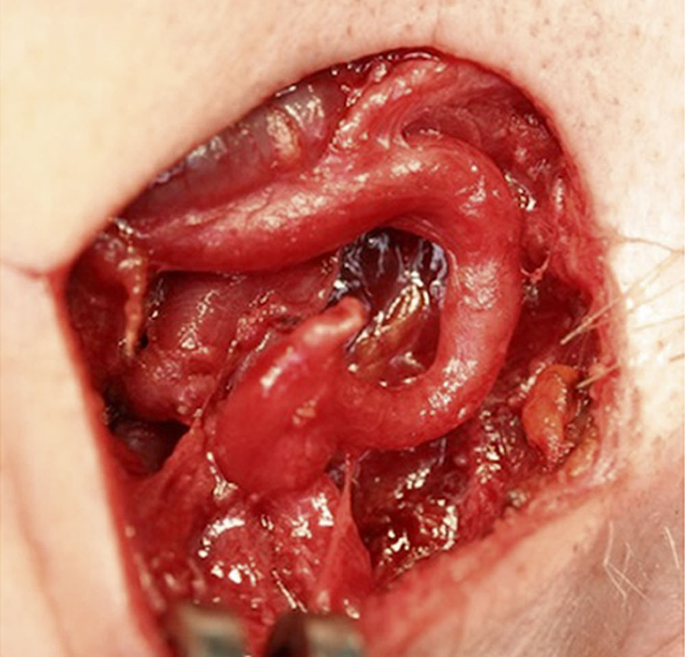 Operationssitus – Arteriovenöse Malformation
