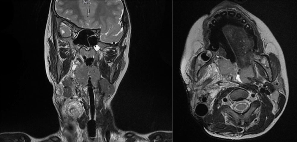 MRT bei mikrozystischer lymphatischer Malformation