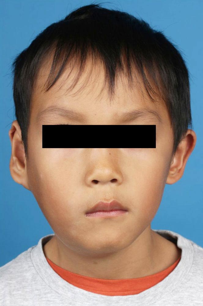 Mikrozystische lymphatische Malformation nach Operation