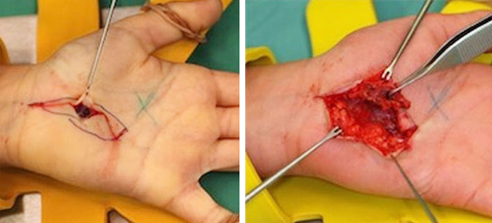 Umschriebene venöse Malformation an Hand