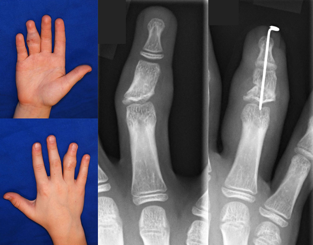 Laser-Therapie einer venösen Malformation