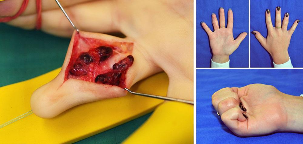 Venöse Malformation – Operation Hand