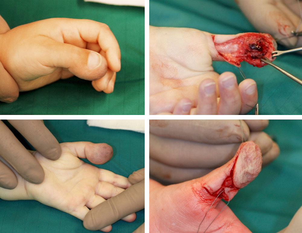 Venöse Malformation – Operation Hand