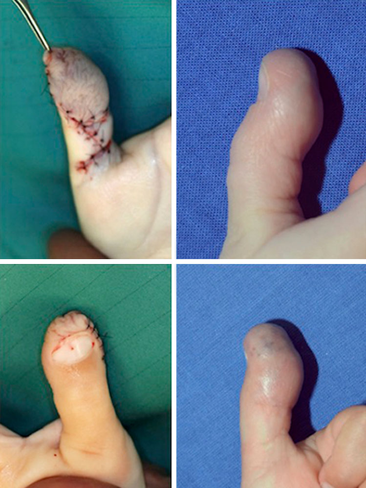 Venöse Malformation an Hand