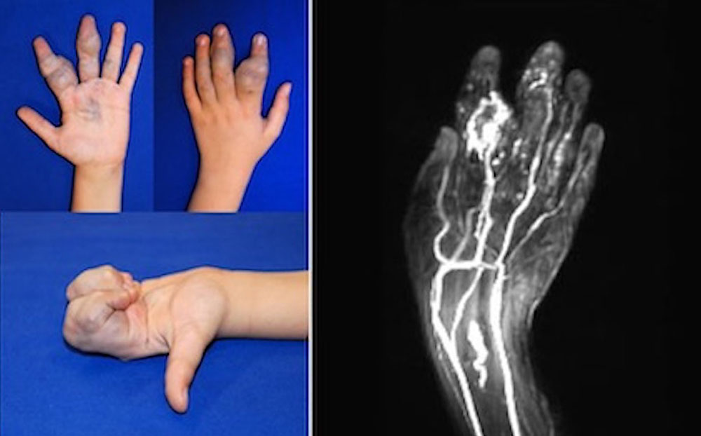 Venöse Malformation an Arm