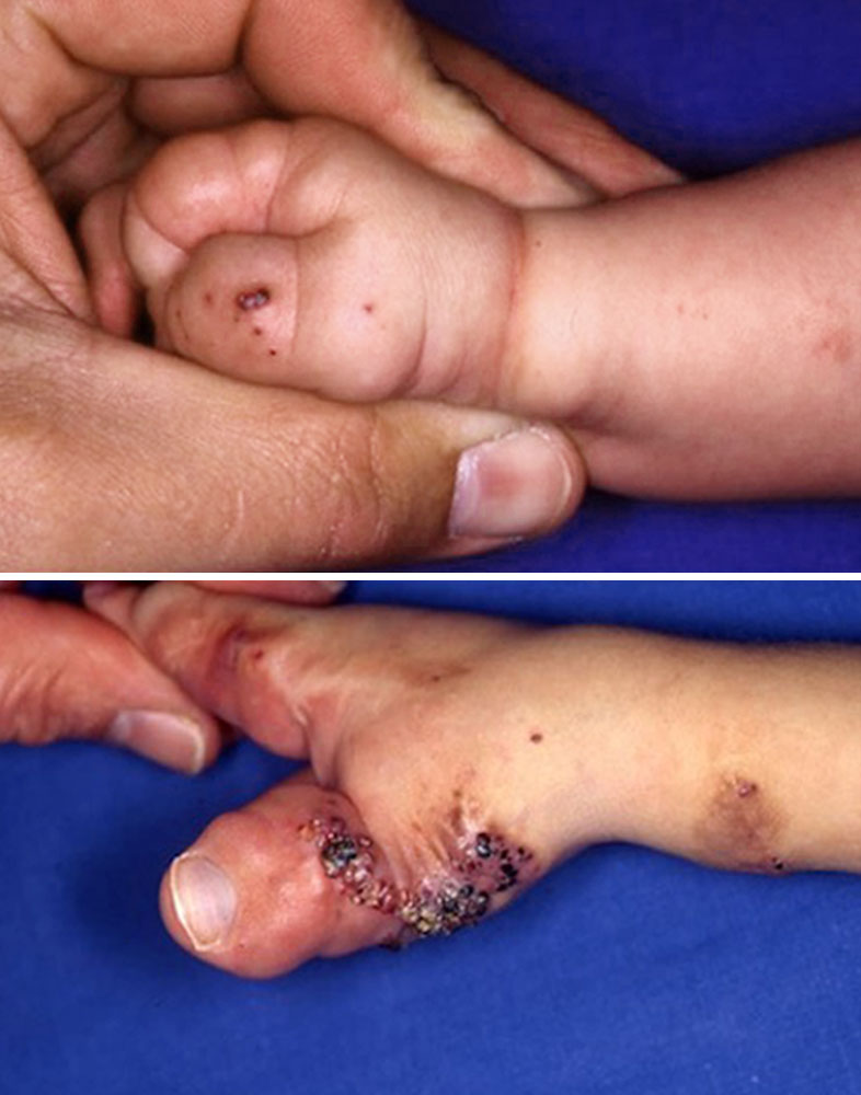 Gemischt venös-lymphatische Malformation an Hand