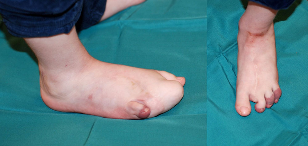 Ergebnis nach Operation am Fuß