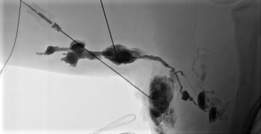 Dilatierter, dysplastischer Lymphleiter bei lymphatischer Malformation – Arm