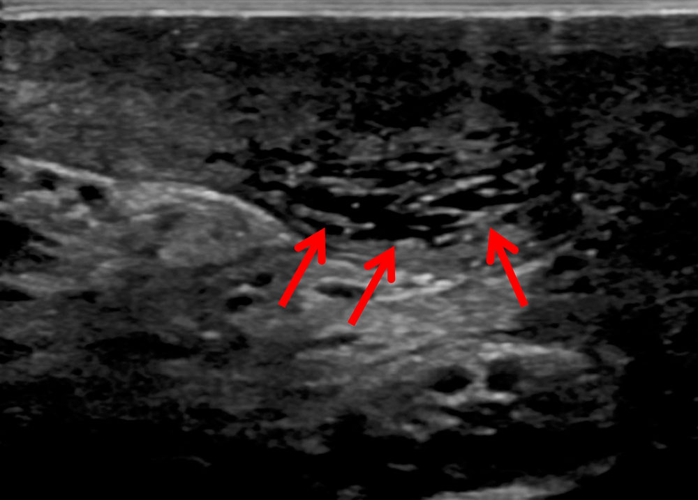 Sonographie eines ausgedehnten subkutanen Lymphödems