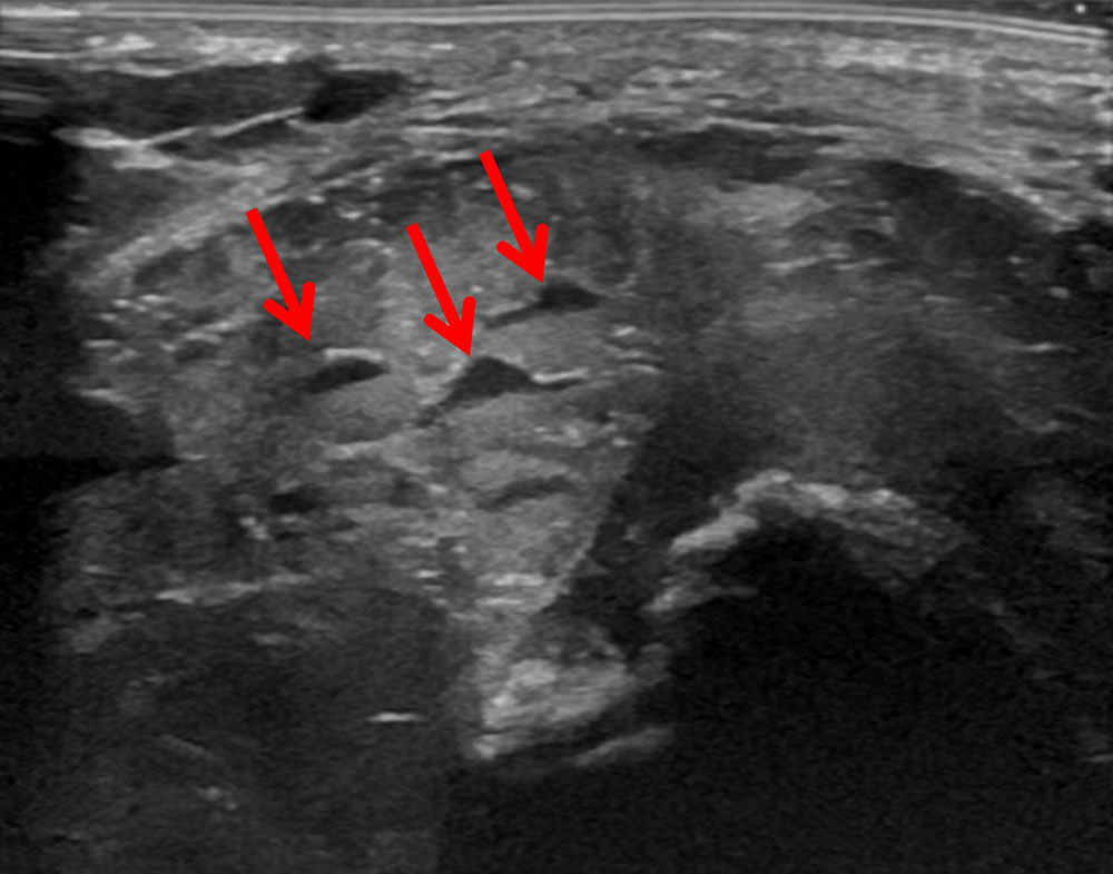Venöse Malformation im Sonogramm
