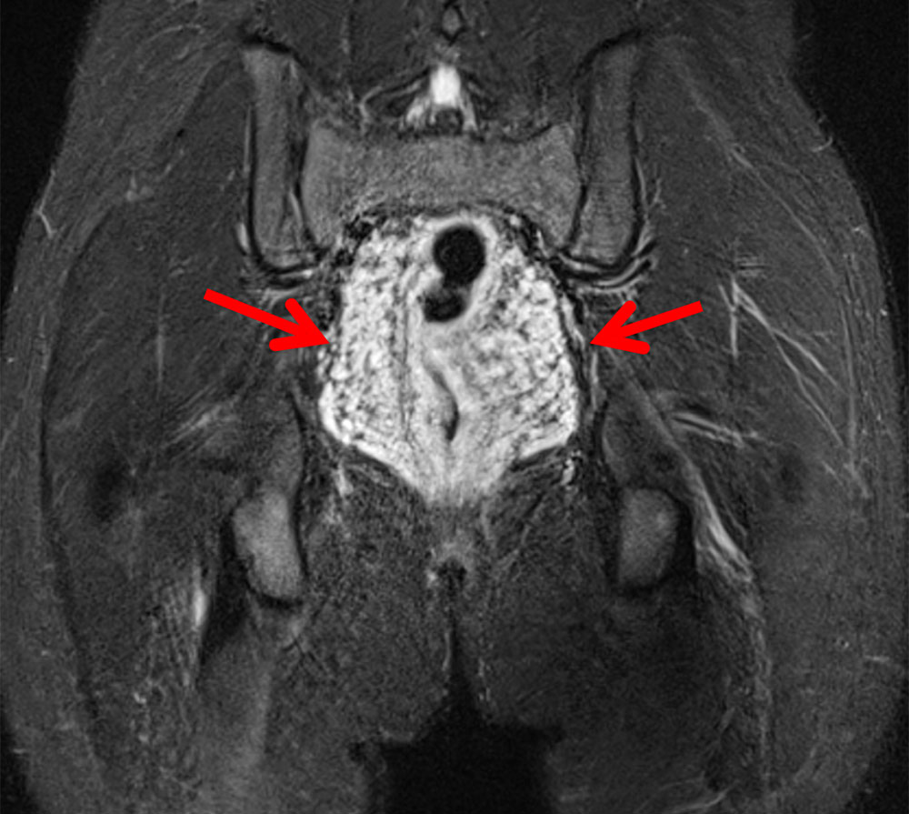 MRT – Venöse Malformation (VM) in Rectum und Colon