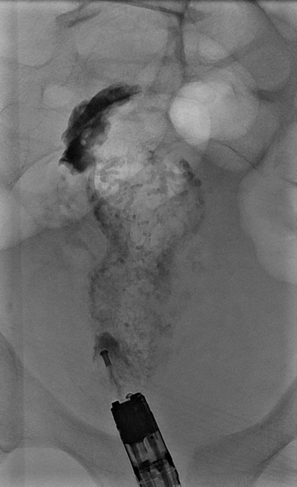 Venöse Malformation in Rectum und Colon