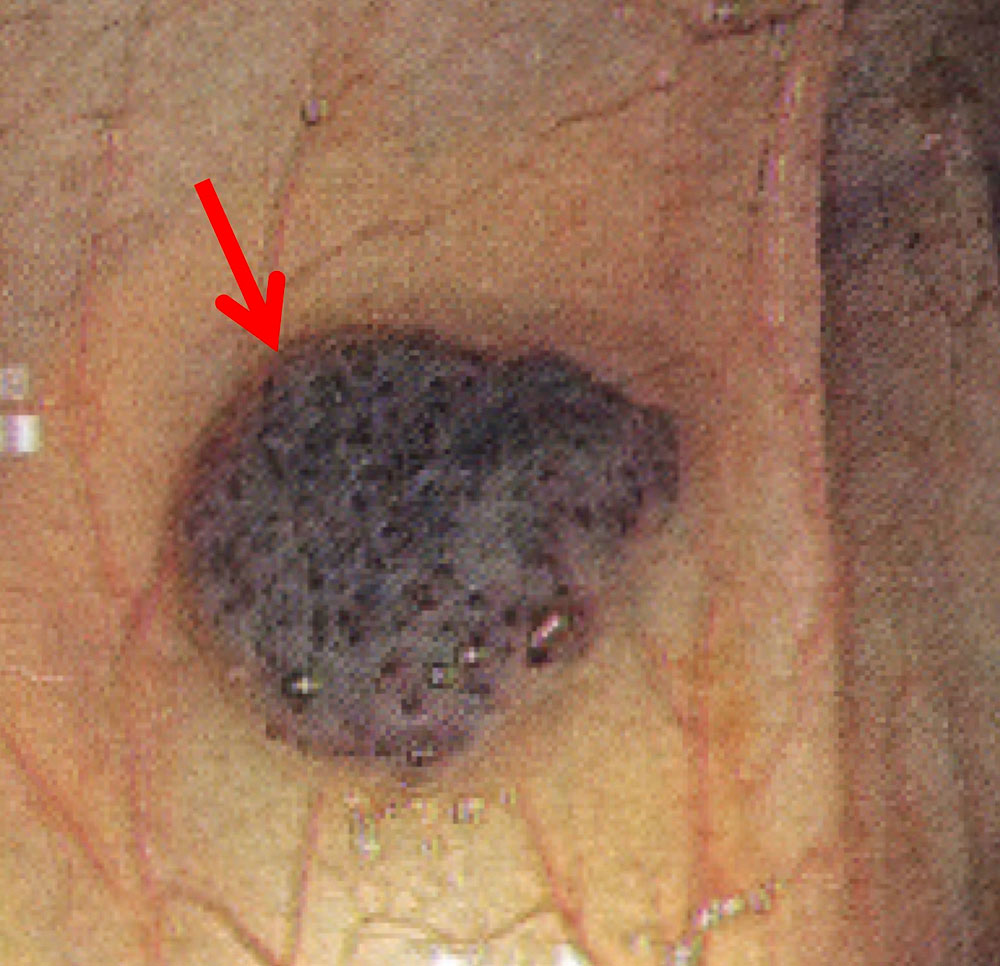 Venöse Malformation in Darm