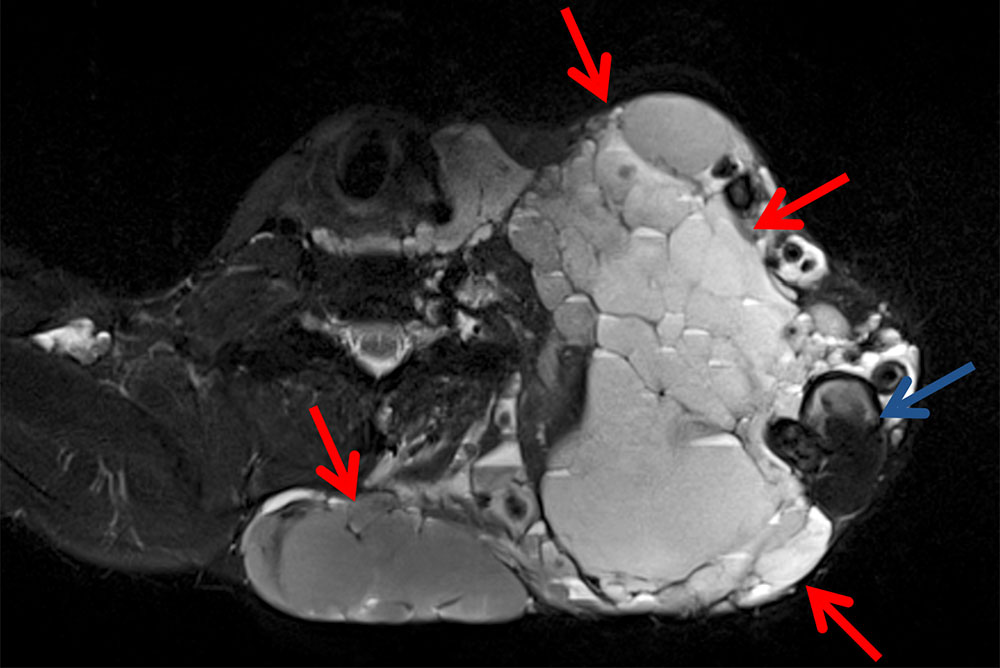 MRT – Venöse Malformation