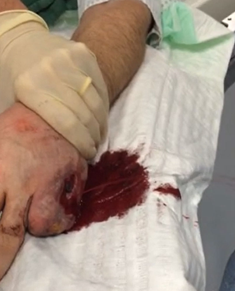 Arteriovenöse Malformation an Hand