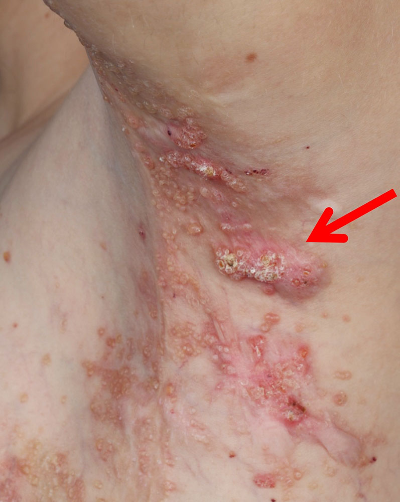 Lymphangioma circumscriptum mit Lymphvesikeln