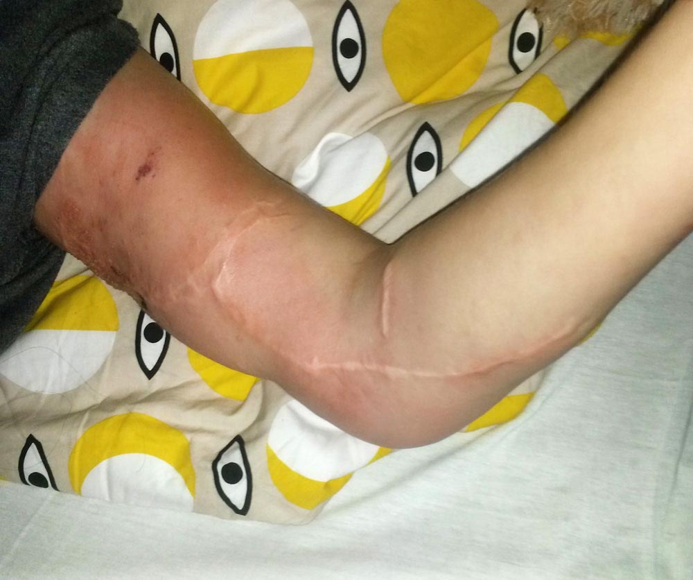 Akutes Erysipel am Arm