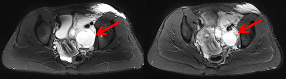 MRT – Abdominelle lymphatische Malformation