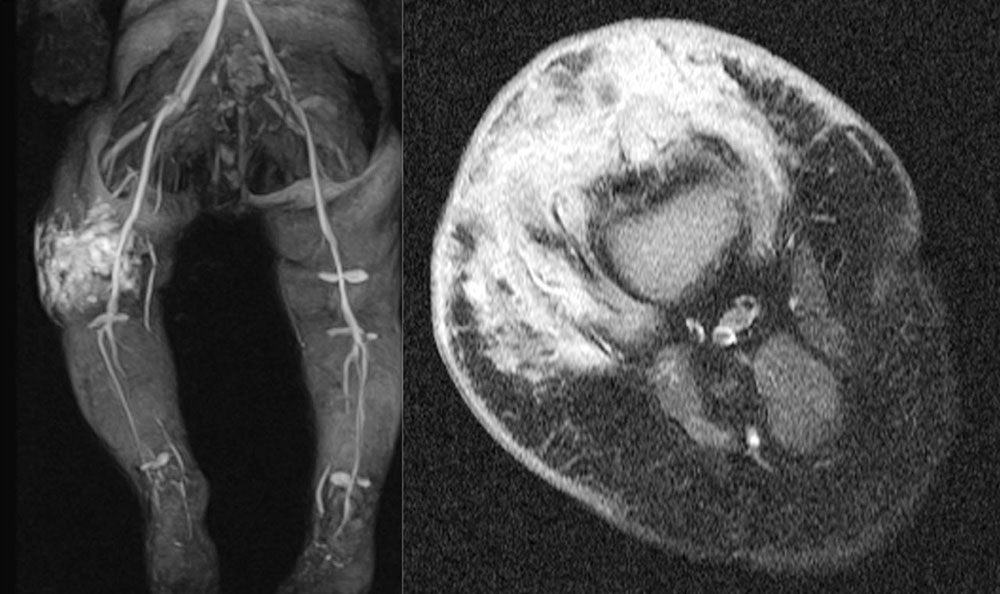 MRT – Kaposiformes Hämangioendotheliom