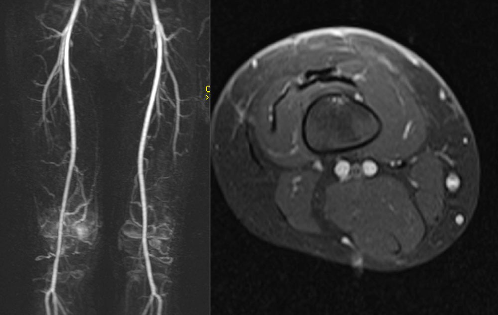 MRT – Kaposiformes Hämangioendotheliom