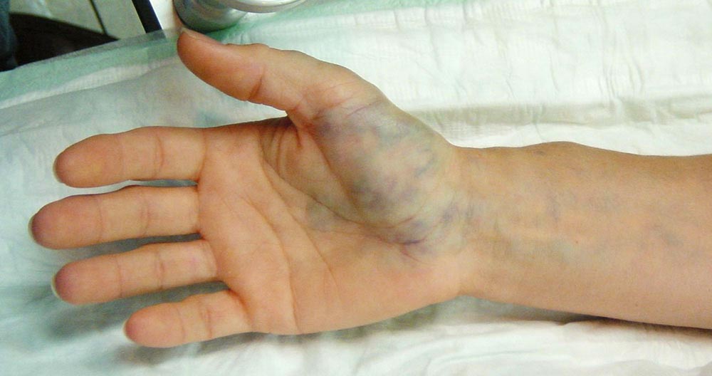 Venöse Malformation an Hand