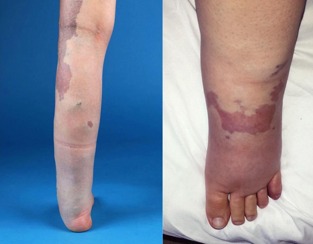 Kombiniertes Lymph- und Phlebödem an Fuß