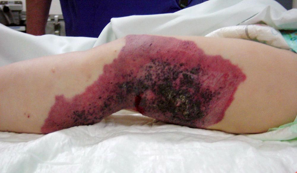 Kapilläre Malformation bei Klippel-Trénaunay-Syndrom
