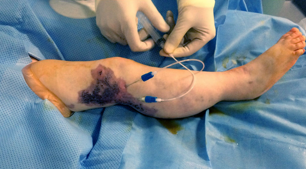 Sklerosierungsbehandlung Lymphorrhoe