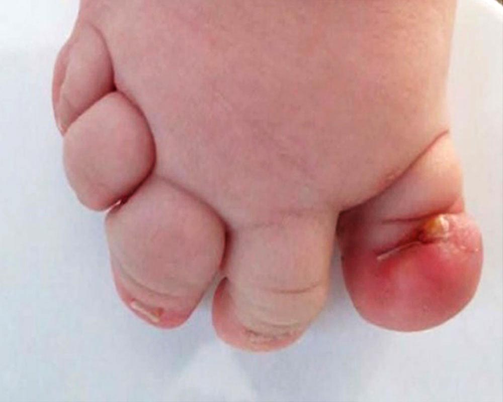 Chronische Nagelbettentzündung an Großzehe