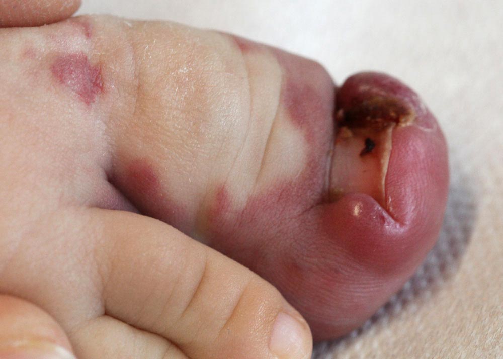 Chronische Nagelbettentzündung bei arteriovenöser Malformation