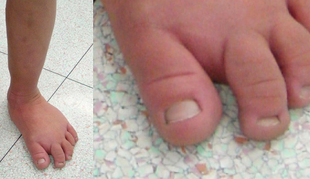 Ballonierte Hyperplasie an Fuß