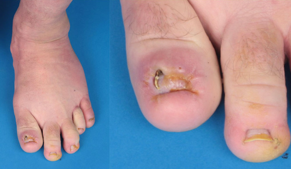 Ballonierte Hyperplasie an Fuß mit immer wiederkehrenden Nagelbettentzündungen