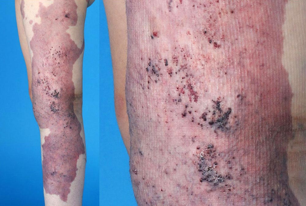 Petechien auf einer kapillär-venolymphatischen Malformation an Bein