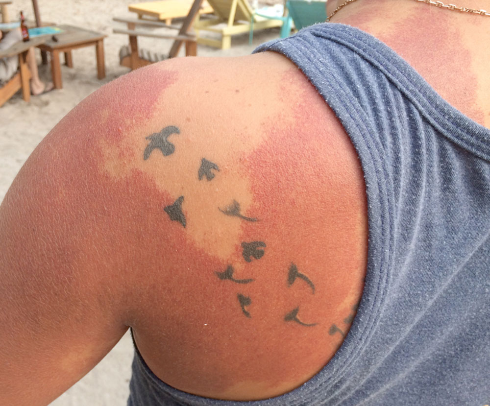 Tattoo im Bereich einer kapillären Malformation
